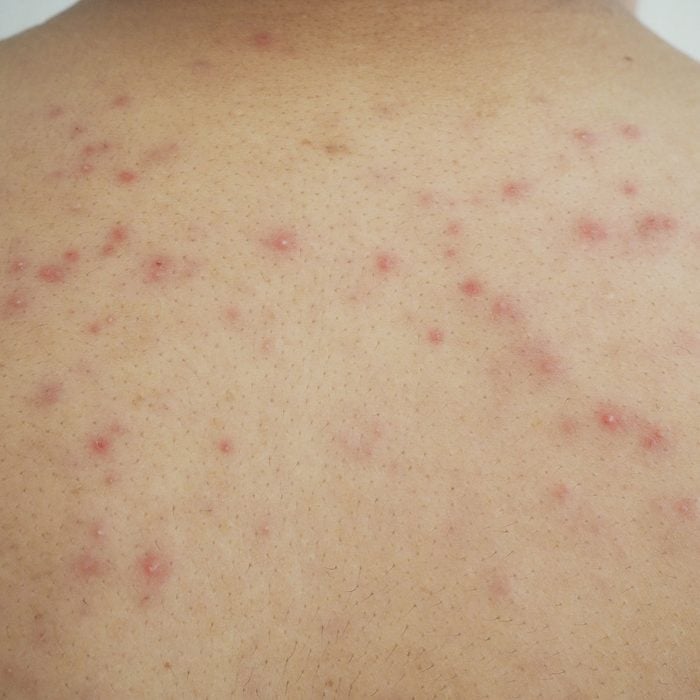 close up of skin with heat rash