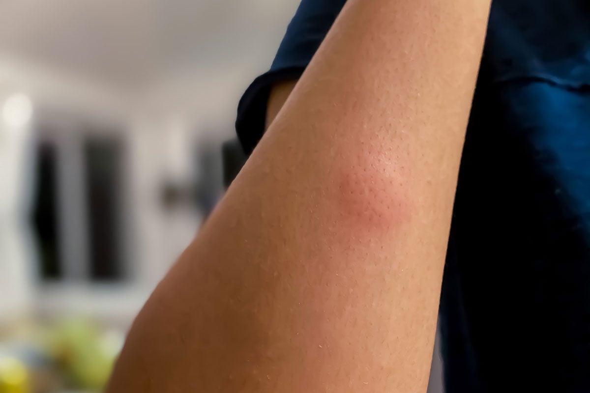 Mosquito Bite