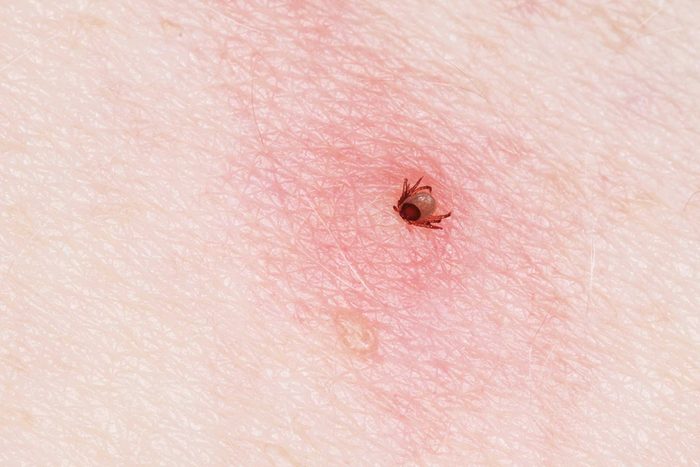 Closeup of a tick burrowing into skin