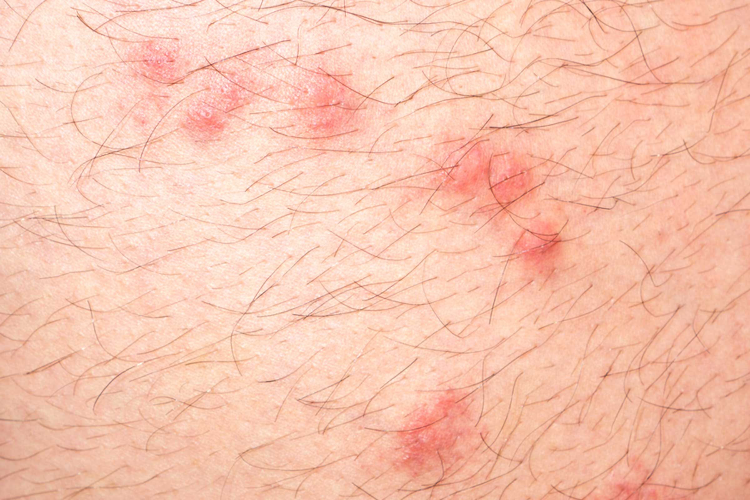 close up of flea bites on human skin